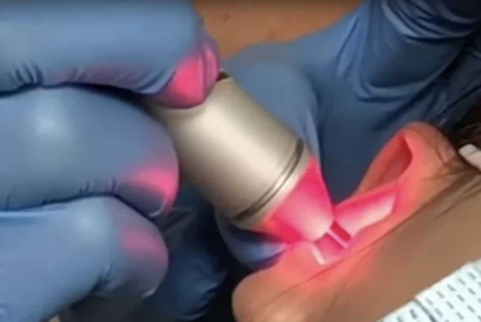 how does a laser session work to stop smoking? laserostop laser smoking cessation